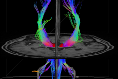 tractografia y subtalamo
